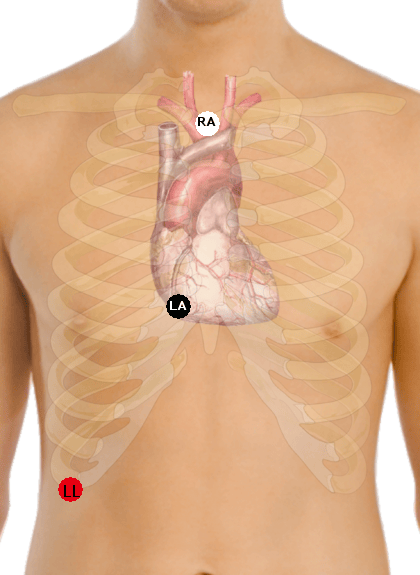 Left Lead The Lewis Lead – The Student Physiologist