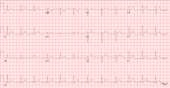 NormalECG