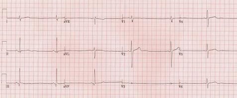 sinus-brady-anorexia-nervosa