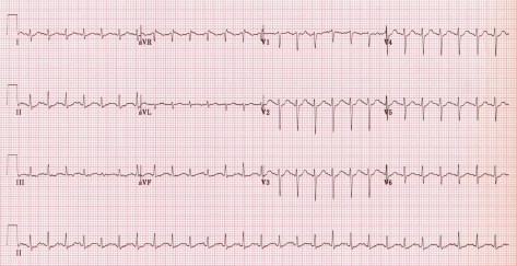sinus-tachycardia
