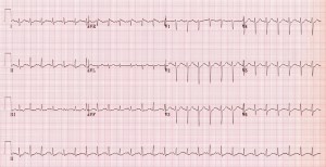 The Sinus Rhythms – The Student Physiologist