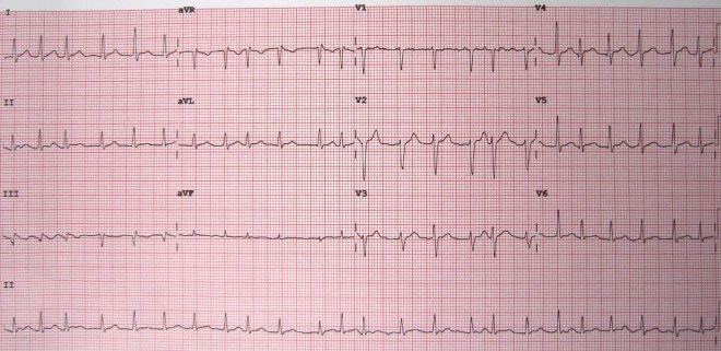 12-lead-ECG-showing-Atrial-Fibrillation-at-approximately-150-beats-per-minute.jpg