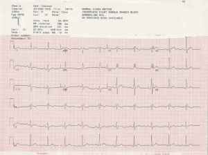 ekg8