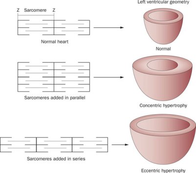 Figure-4-Concentric-and-eccentric-hypertrophy-can-be-distinguished-by-the-orientation-in