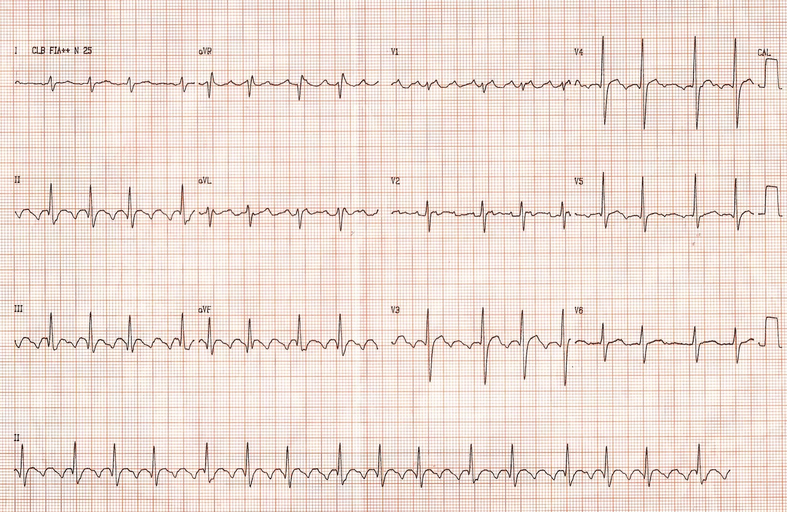 Atrial Flutter – The Student Physiologist