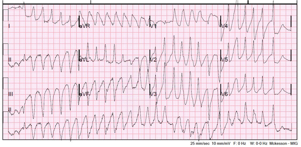 Ventricular Tachycardia – The Student Physiologist