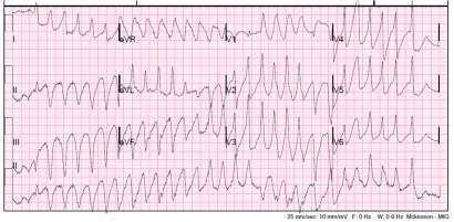 12-lead in polymorphic VT-later