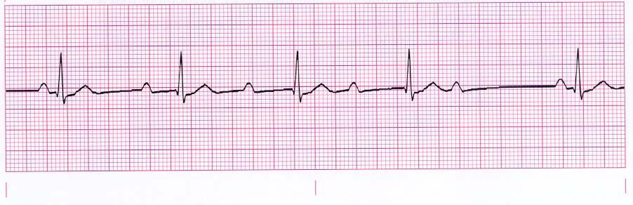 AV Blocks – The Student Physiologist