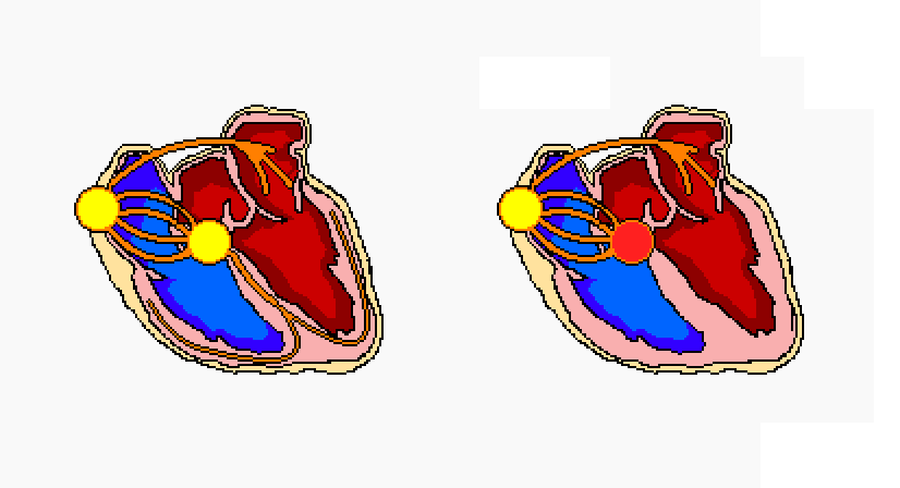 AV Blocks – The Student Physiologist