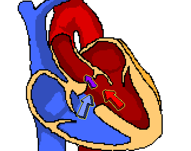 Tetralogy of Fallot
