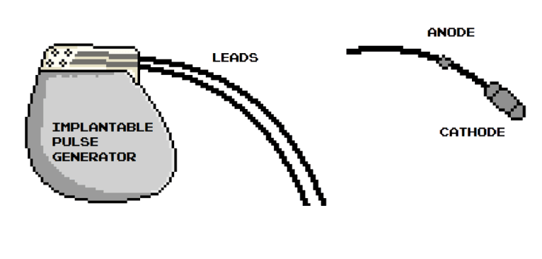 Pacemaker Hardware Pacemaker Components – The Student Physiologist