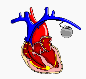 Basic Pacing Modes – The Student Physiologist